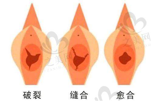 术后一个月:成效初现的喜悦