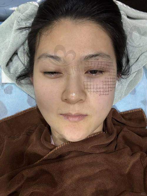 韩国热玛吉全脸价格多少钱一次——热门机构价格对比