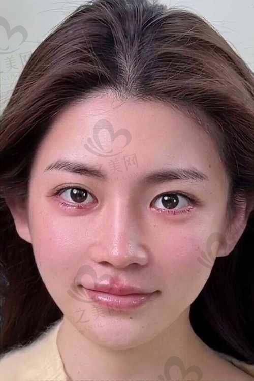 韩国热玛吉全脸价格多少钱一次——五代热玛吉价格情况