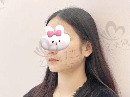 术后第一天:初见成效的惊喜