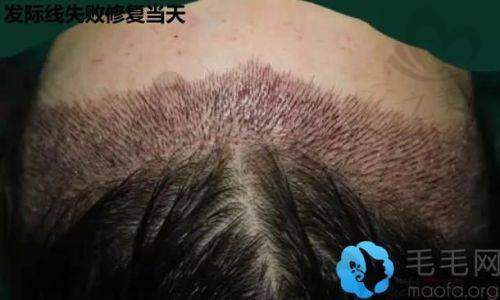 韩国毛茂MOMO植发医院价格贵吗——价格与服务质量的平衡