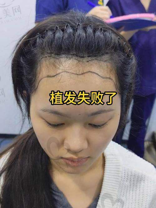 韩国毛茂MOMO植发医院价格贵吗——与国内植发价格对比