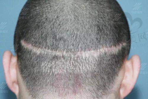 韩国毛茂MOMO植发医院价格贵吗——价格背后的技术支撑