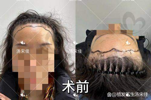 韩国毛茂MOMO植发医院价格贵吗——顾客评价中的价格合理性