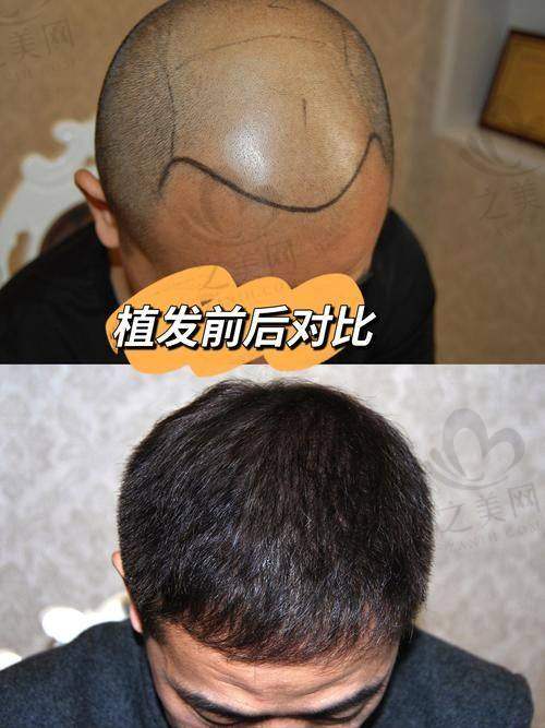 韩国毛茂MOMO植发医院价格贵吗——综合考量后的价格优势