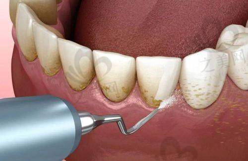 牙龈癌的肿块是怎样的？了解位置、形态、质地及症状，助你早发现早治疗