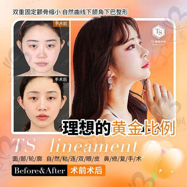 韩国TS整形医院怎么样? 在本地做眼睛技术赞价格实惠