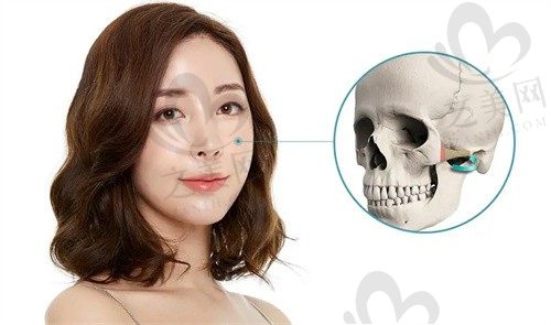 上海时光医院何晋龙医生颧骨整形案例,术后效果对比图赏析