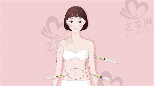 程鹏医生吸脂整形怎么样?想做吸脂到广州曙光医学美容医院预约挂号