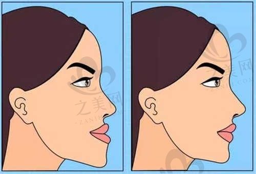 台州府城口腔医院毕洪海医生种植牙仅2k+，让你拥有一口好牙