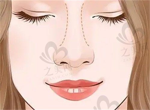 冯春雨医生做鼻子怎么样?挺不错的,还有案例来这看