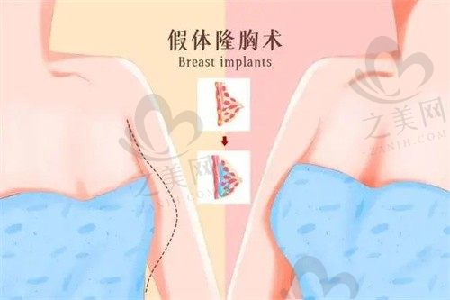 合肥品奈医疗美容门诊部吴厚生隆胸好吗?技术好,形态自然流畅