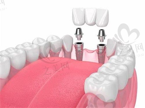 种植牙价格怎么样_之美网