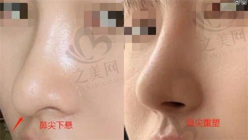 我花大价钱隆鼻后鼻子却歪了,还好郴州唯美的鼻修复让我重新拥有了美丽