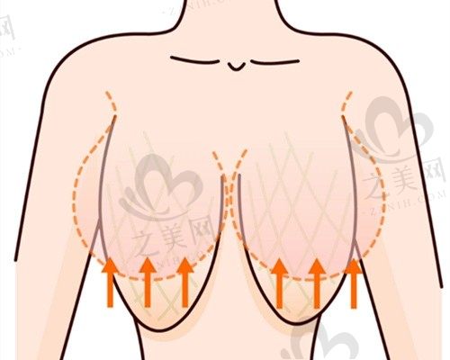 乳房下垂怎样恢复紧实?我做了双环法乳房下垂矫正术恢复效果好