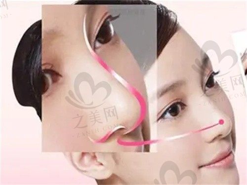 青岛诺美德隆鼻谁做的好?曹继武、徐长帅、王刚医生评价都挺高