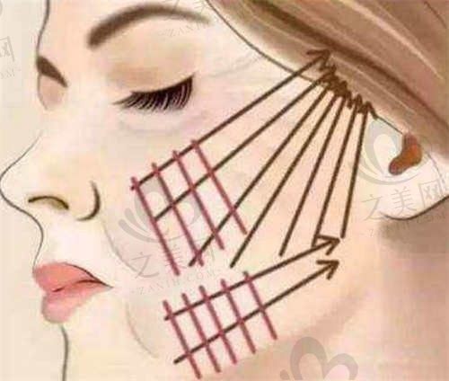 周口雅美天成拉皮李全民拉皮4800元起，创口小痛感低恢复快