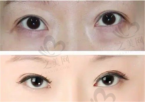 武汉倾美医疗美容门诊部赵涛不开刀祛眼袋仅需26800元起，无切口零伤痕