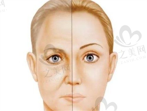 武汉五洲整形外科医院刘杨自体脂肪面部充填1.5w元起，改善面部凹陷