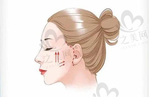 泉州丰泽弗丽嘉高祥医生做轮廓提升29800元起，做完脸部轮廓更精致