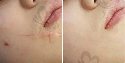 西安禾悦医疗美容门诊部地址在哪?做除腋臭手术效果好吗