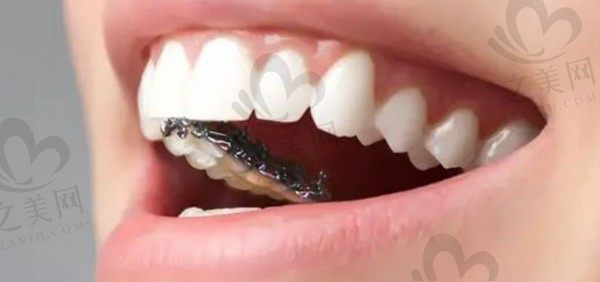 杭州艺星口腔医院好不好呀?听听我在艺星口腔做种植牙的经历