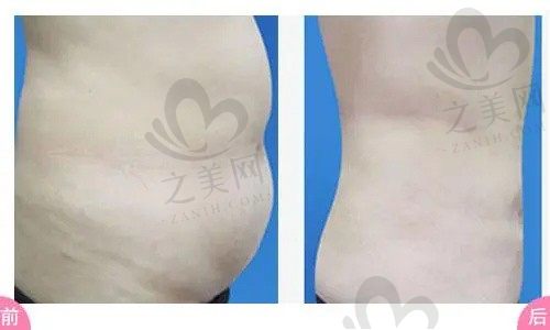 北京美莱王志军做腰腹抽脂价格15000元起，创口小，效果明显