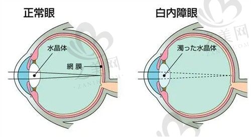 我在昆明康特森眼科医院找王慧医生做白内障8800元起,效果真的不错