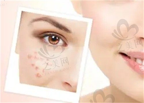 北京京城皮肤医院杨晶红蓝光祛痘300元起，做完改善明显