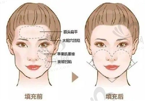 北京艺星自体脂肪面部填充怎么样?效果自然价格合理口碑好!