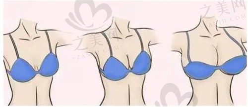 上饶韩美医疗美容门诊部童晓江吸脂隆胸15000元起，创伤小恢复快，效果还挺好