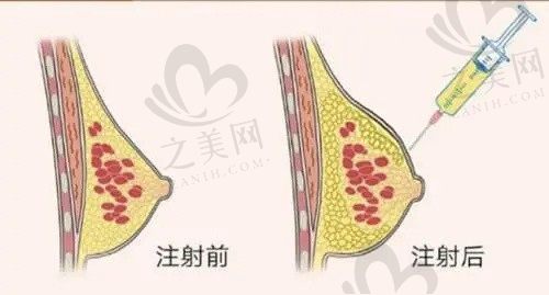 洛阳西工孔繁荣医疗美容门诊部何康自体脂肪隆胸8000元起，打造饱满胸型