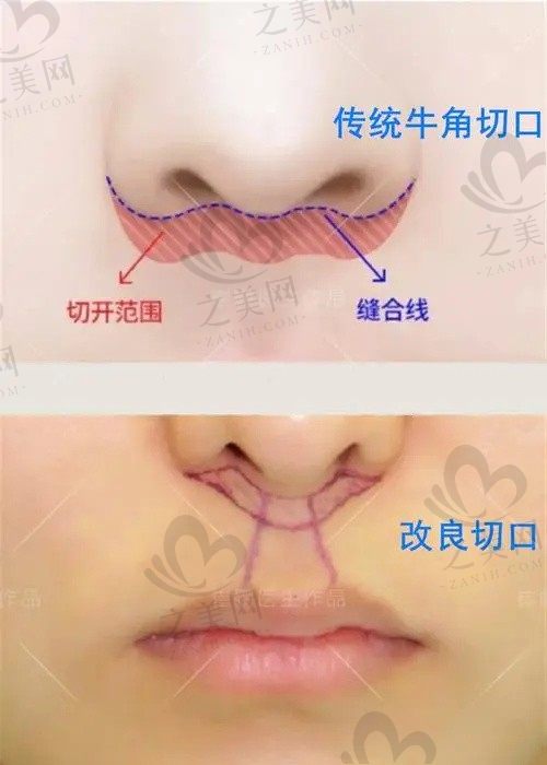 深圳胡俊杰人中缩短做的好吗?深圳福雅免拆线人中缩短术后好自然