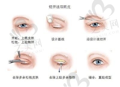 长沙华韩华美医疗美容医院孙玥玥医生切开双眼皮4630元起，非常自然流畅