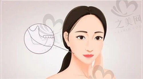 北京圣嘉新张笑天做下颌角截骨手术38000元起，手法精巧很自然