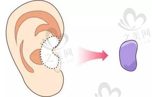 深圳宝丽李信锋耳软骨鼻综合价格68000元起，打造精致鼻型