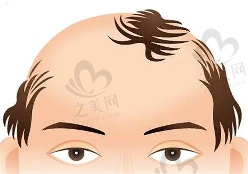 碧莲盛BHT植发技术怎么样?来看看北京碧莲盛植发价格表和医生推荐!