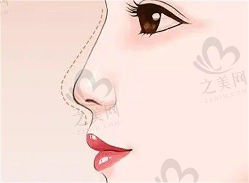 长沙艺星医学美容医院王成云耳骨垫鼻子仅需6800元起，手术安全且效果好