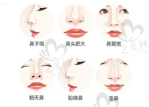 洛阳毛大夫普潇做鼻子怎么样?采用微创技术,术后恢复不留疤痕