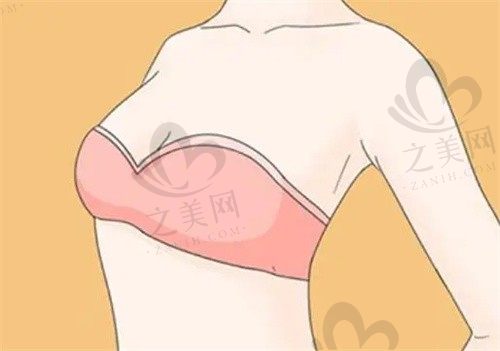 武汉五洲整形外科医院刘杨巨乳缩小2w元起，理想解决胸部疑难问题