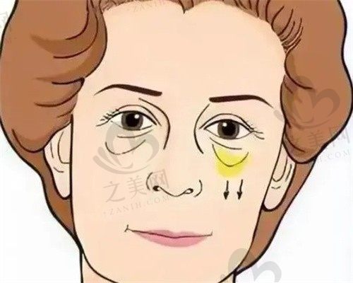 北京米兰柏羽丽都高海燕祛眼袋价格3980元起，手术评价非常高