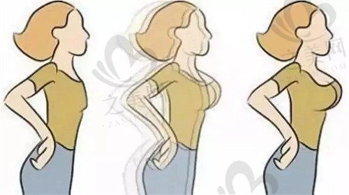 江苏常州多美医疗美容门诊王忠医生动态丰胸2w元起，胸型自然且手感真实