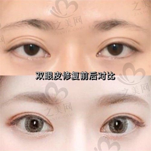 林靖双眼皮修复怎么收费?3-5万左右,林靖双眼皮修复满意度高