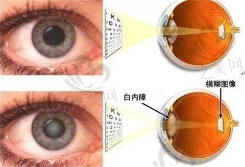 南宁爱尔眼科医院白内障手术多少钱?人工晶体1200元起收费不高