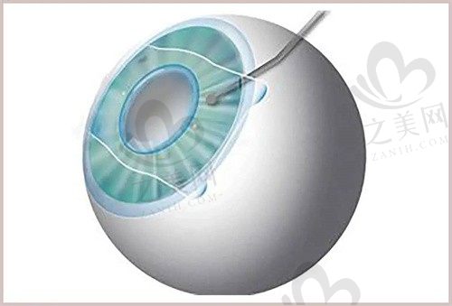 上海爱尔眼科医院和新视界医院哪家好?从医院资质和价格对比看都不错