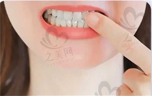 我在达州医大口腔医院的种牙分享,终于可以痛快的吃东西了
