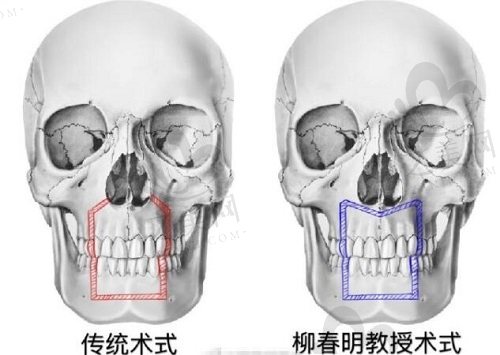 柳春明M形截骨