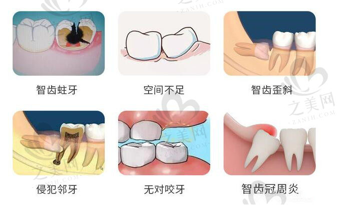 智齿拔除