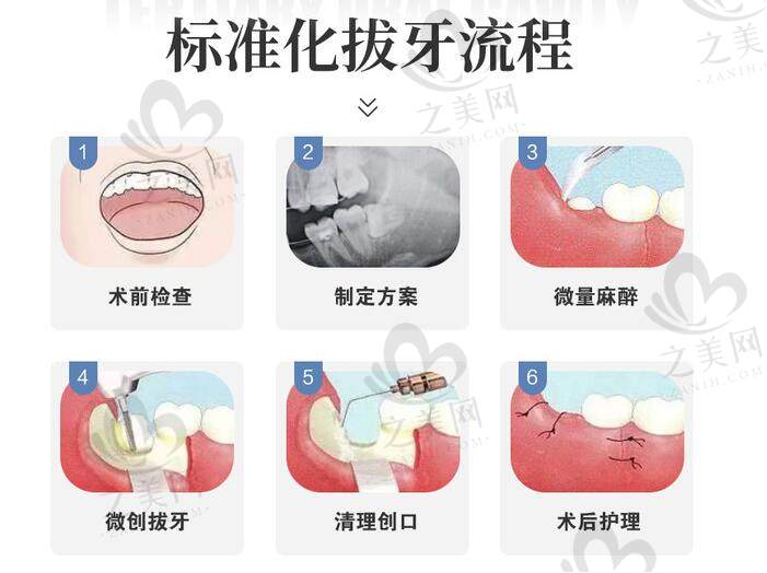 拔牙流程