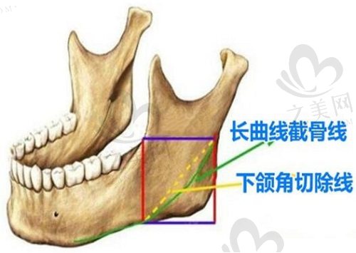 李志海长曲线下颌角磨骨技术